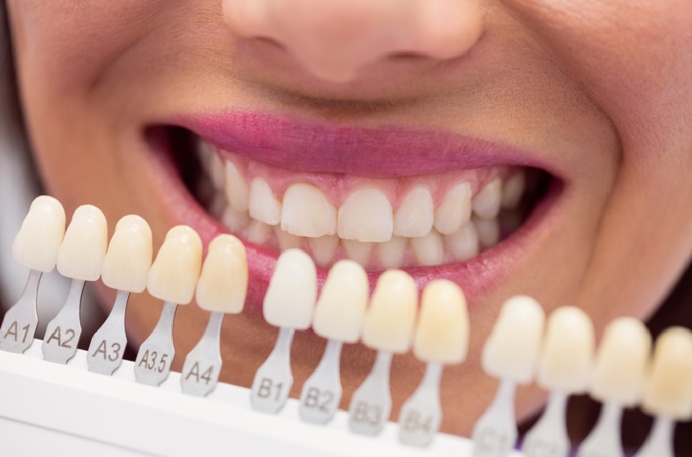 Dental Veneers